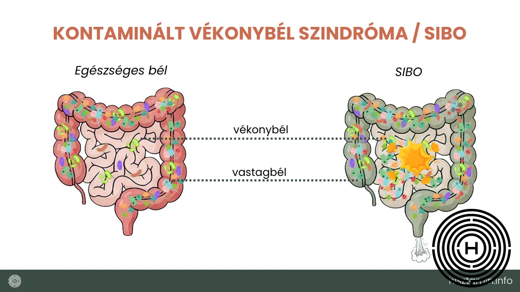 SIBO infografika, amin látható a baktériumok elszaporodésa a vékonybélben